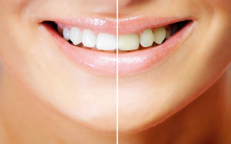 Teeth Whitening: Safe Methods for a Brighter Smile